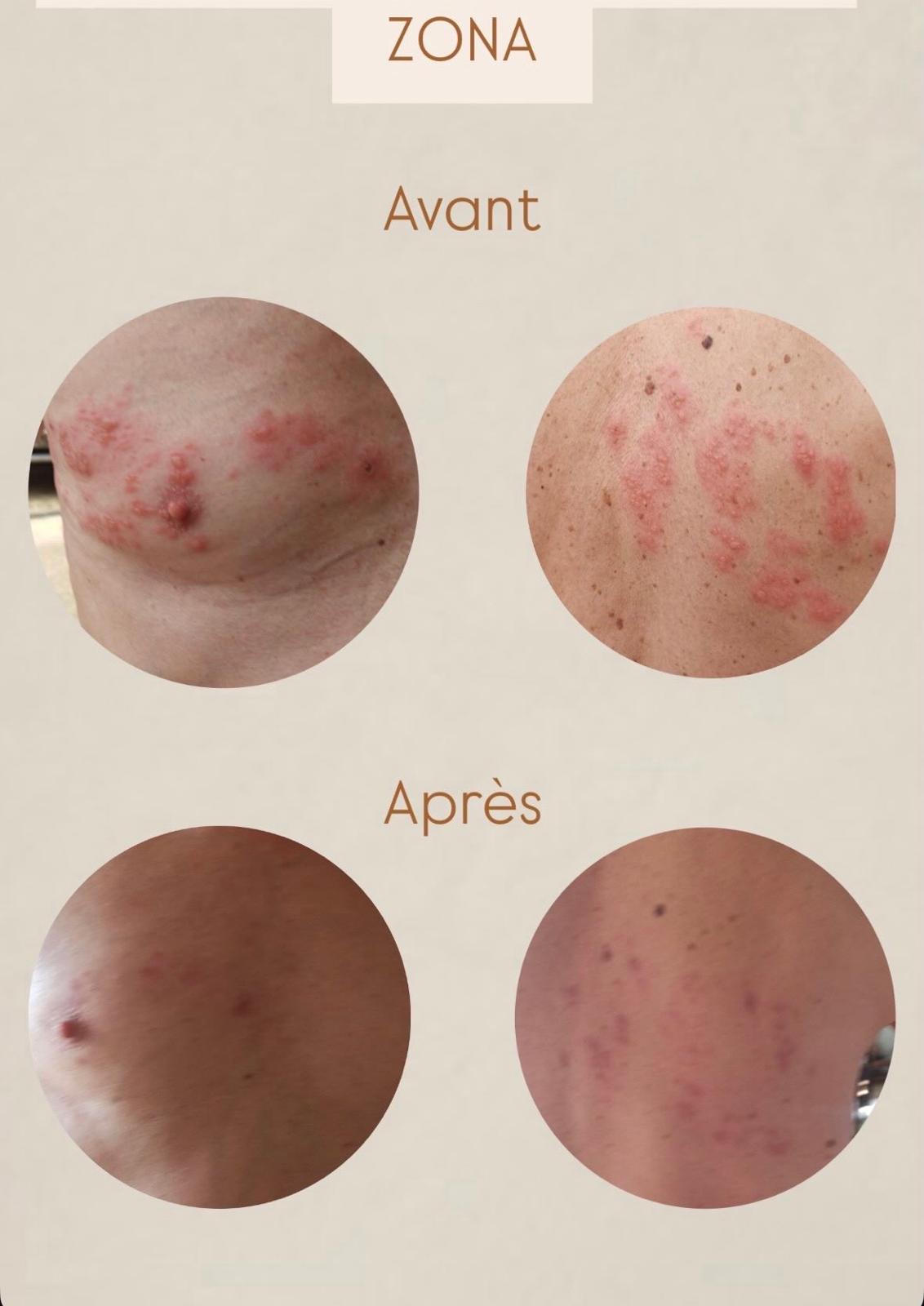 Évolution photographique avant et après pour un zona