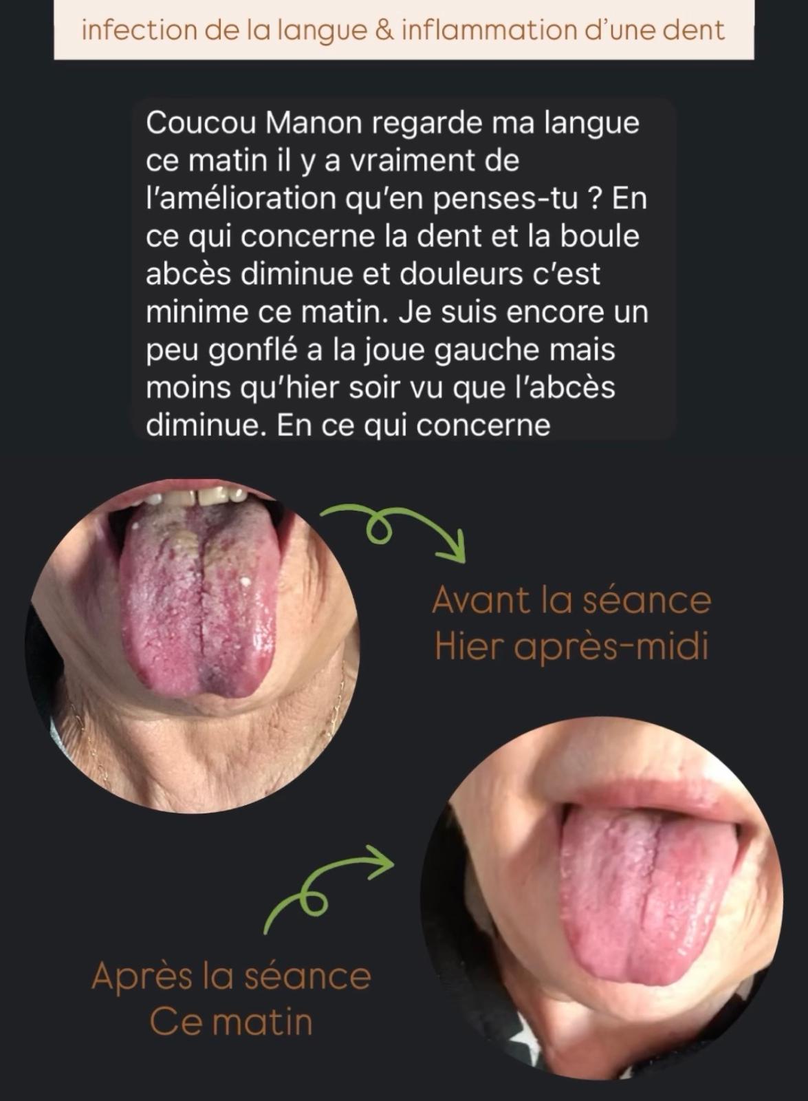 Évolution photographique de la langue avant et après une séance