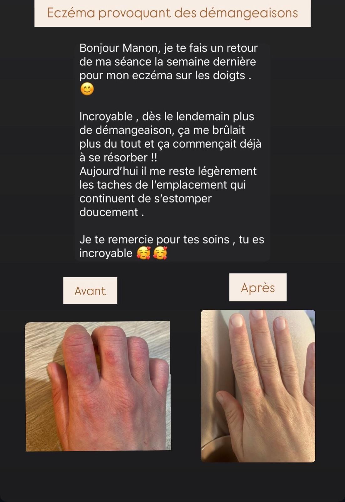 Évolution avant et après d’un eczéma sur les doigts