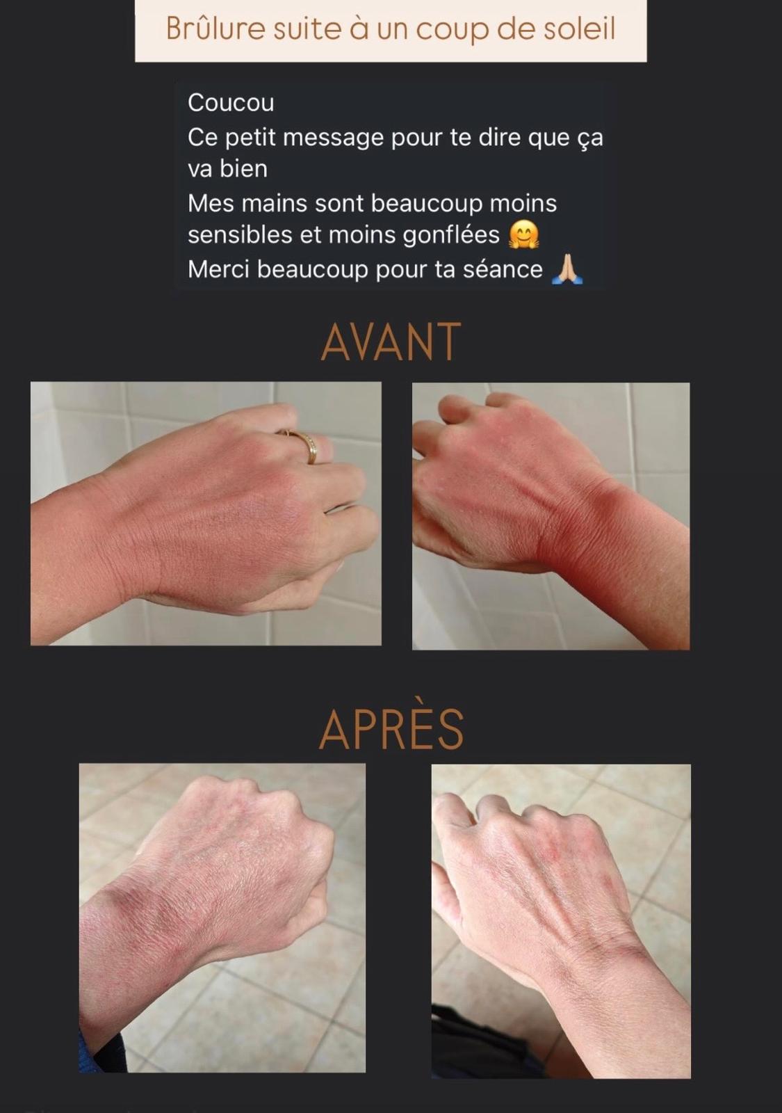 Évolution avant et après d’une brûlure liée à un coup de soleil sur les mains