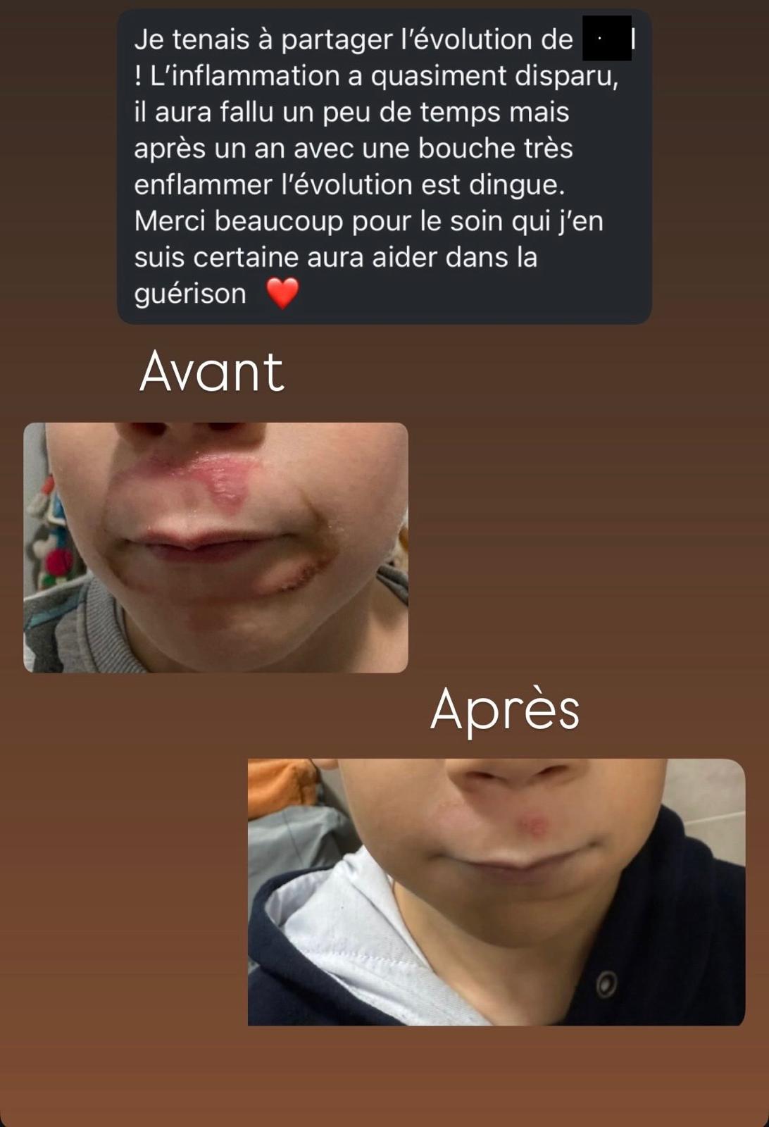 Évolution photographique avant et après d’une inflammation autour de la bouche