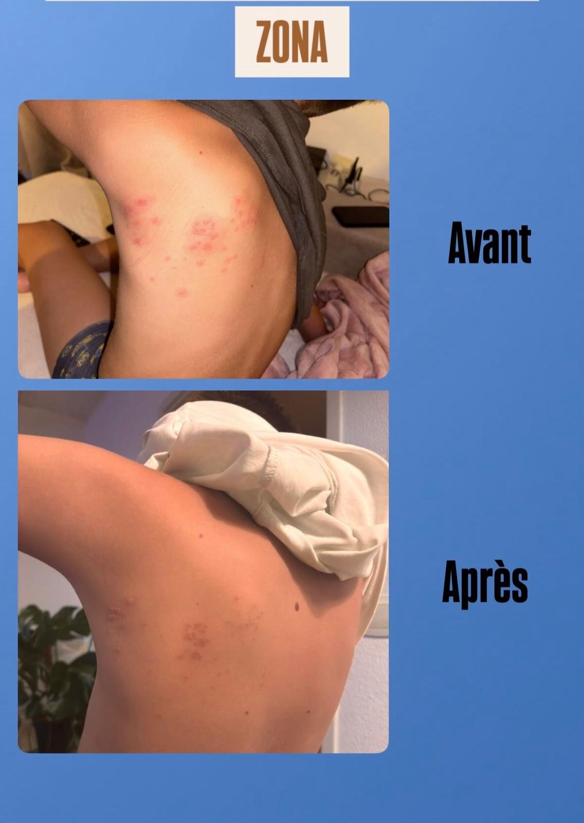 Évolution photographique avant et après d’un zona près de l’aisselle